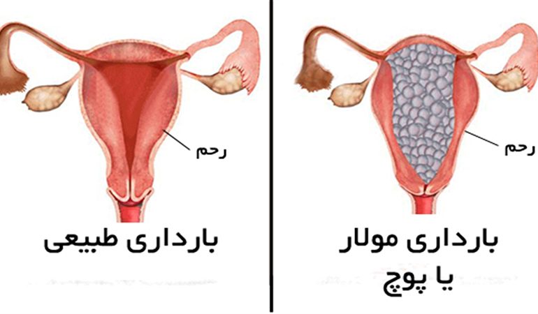 متخصص زنان بجنورد | حاملگی مولار چیست