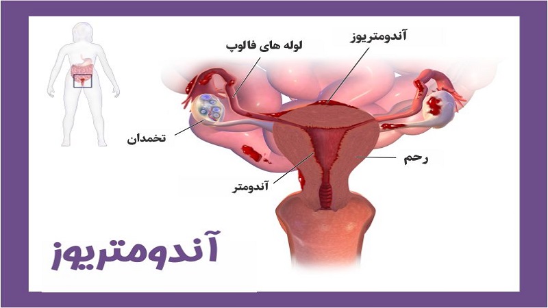 آندومتریوز و ناباروری | متخصص زنان بجنورد