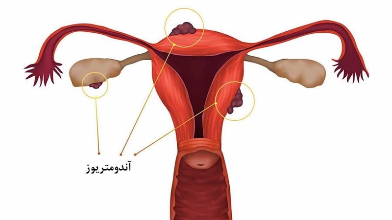 آندومتریوز و ناباروری | متخصص زنان بجنورد