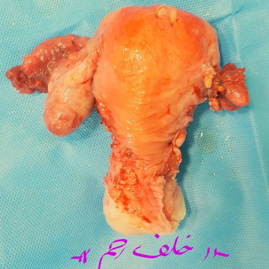 خروج رحم و تخمدان چپ | متخصص زنان بجنورد