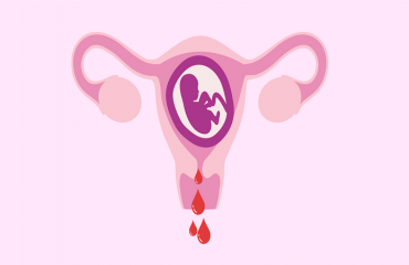 متخصص زنان بجنورد | 6 دلیل بروز خونریزی در بارداری
