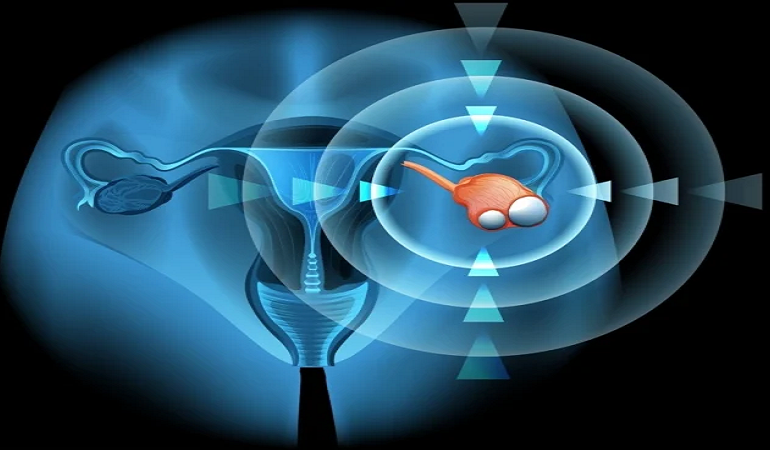 متخصص زنان بجنورد | آیا کیست هموراژیک تخمدان نیاز به درمان دارد؟