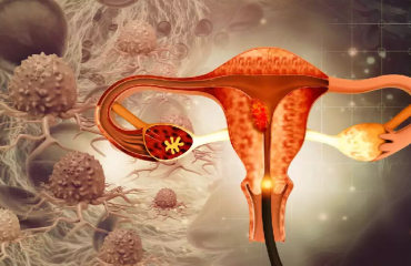 متخصص زنان بجنورد | آیا سرطان تخمدان کشنده است؟
