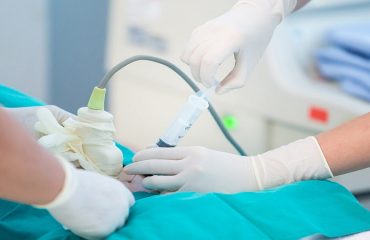 متخصص زنان بجنورد | نمونه برداری از پرزهای جفت (cvs)
