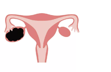 متخصص زنان بجنورد | Endometrioma cyst