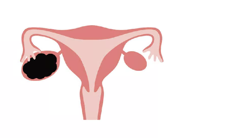 متخصص زنان بجنورد | Endometrioma cyst