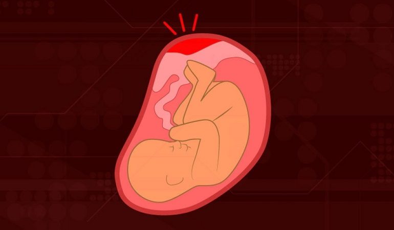 متخصص زنان بجنورد | عوامل و علائم جدا شدن زودرس جفت