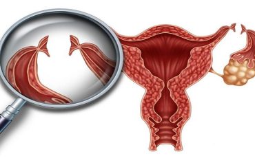 از جراحی توبکتومی چه می دانید ؟