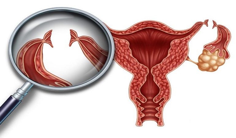 از جراحی توبکتومی چه می دانید ؟