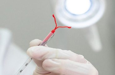 متخصص زنان بجنورد | دکتر آرزو سعیدی | بهترین متخصص زنان بجنورد | عوارض شایع IUD دستگاه داخل رحمی