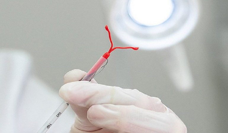 عوارض شایع IUD دستگاه داخل رحمی